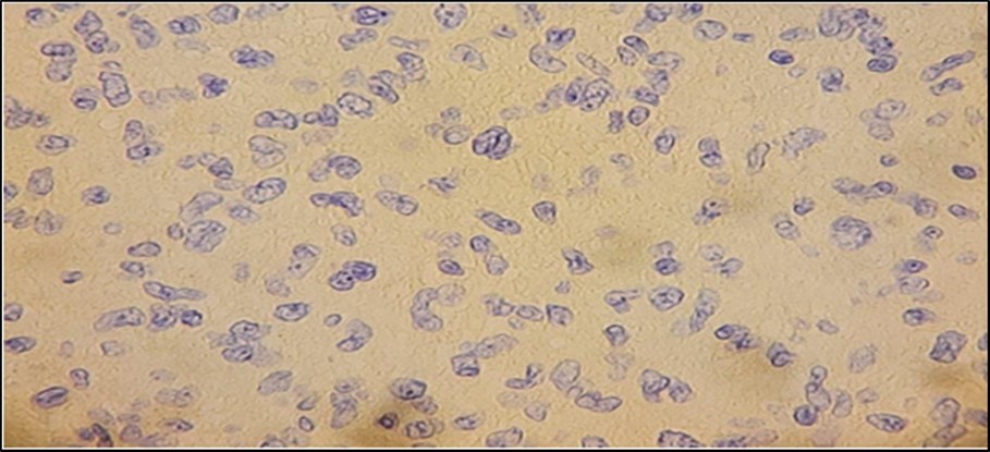 Journal of Ophthalmic Science-Neurofibroma