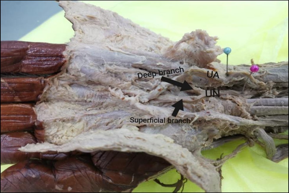 International Journal of Human Anatomy-Ulnar nerve