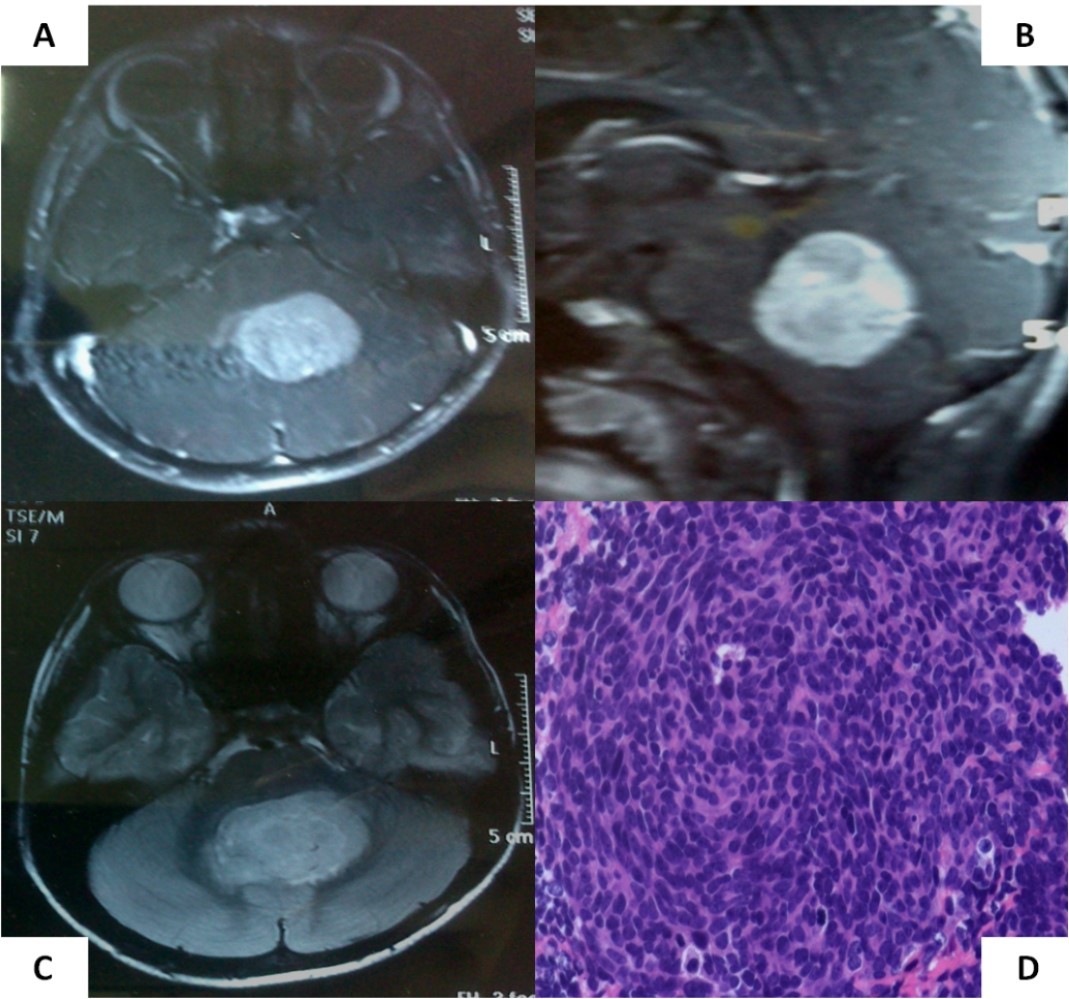 Journal of Brain And Spinal Cancer-medulloblastoma
