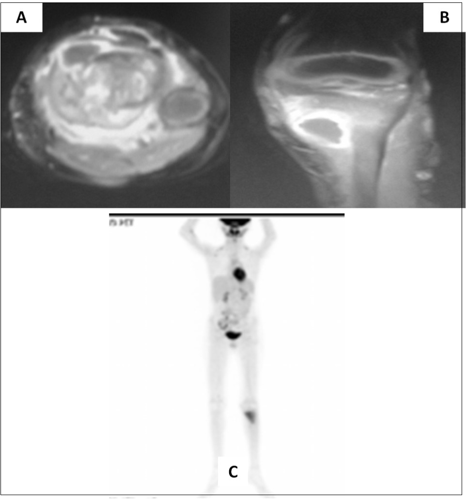 Journal of Brain And Spinal Cancer-medulloblastoma