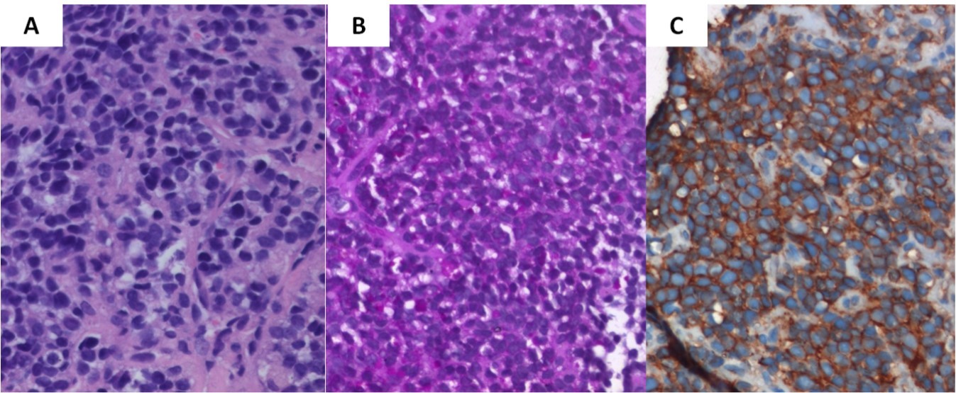 Journal of Brain And Spinal Cancer-medulloblastoma