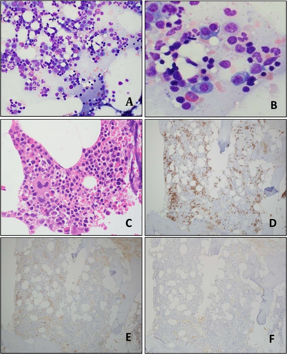 Journal of Hematalogy and Oncology Research-Monoclonal gammopathy of undetermined significance