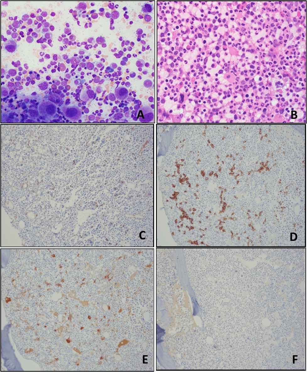Journal of Hematalogy and Oncology Research-Monoclonal gammopathy of undetermined significance