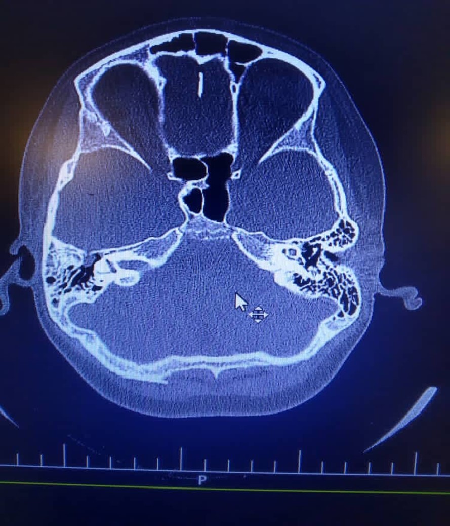 Journal of Diseases-bacterial meningitis