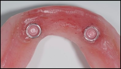 Journal of Dentistry And Oral Implants-Implants