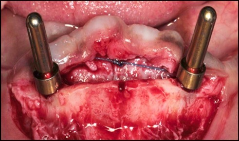Journal of Dentistry And Oral Implants-Implants