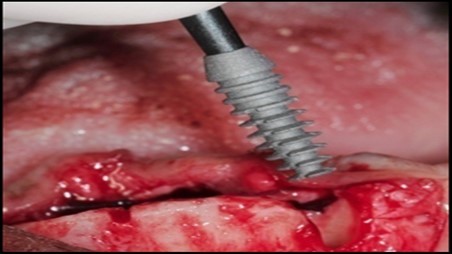 Journal of Dentistry And Oral Implants-Implants
