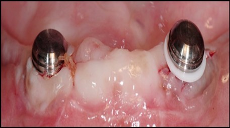 Journal of Dentistry And Oral Implants-Implants