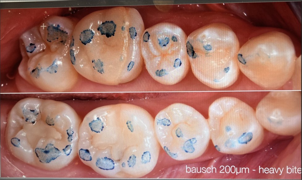 Journal of Dentistry And Oral Implants-Occlusion