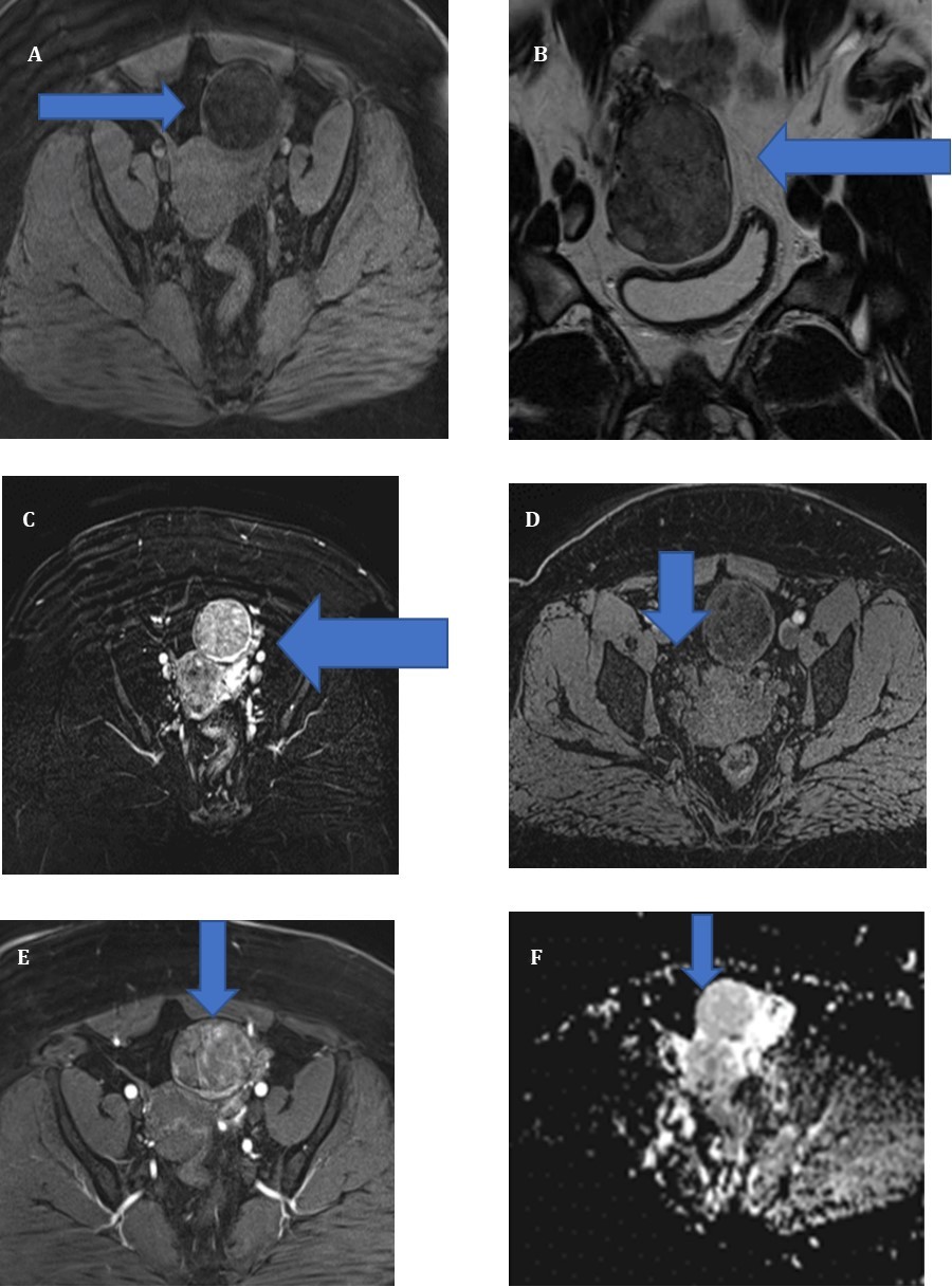 Journal of Digestive Disorders And Diagnosis-Non-specific steroid cell tumor of the ovary (SCT-NOS)