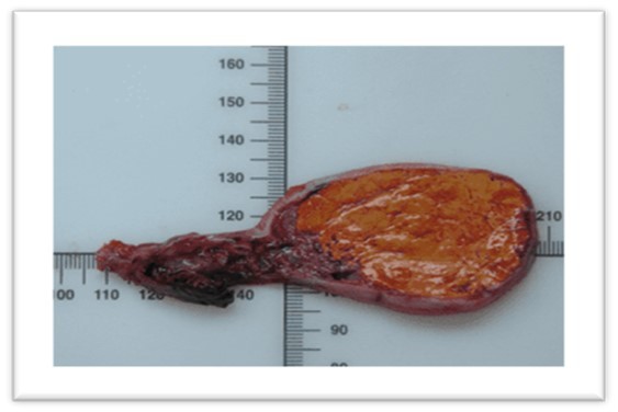 Journal of Digestive Disorders And Diagnosis-Non-specific steroid cell tumor of the ovary (SCT-NOS)