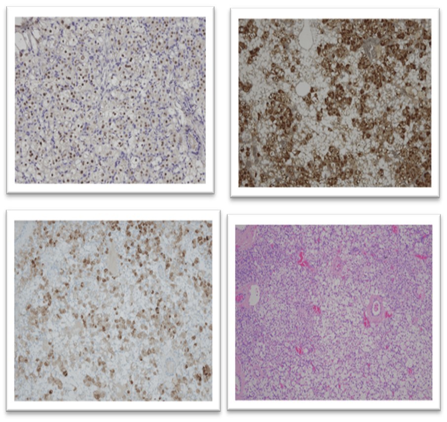 Journal of Digestive Disorders And Diagnosis-Non-specific steroid cell tumor of the ovary (SCT-NOS)