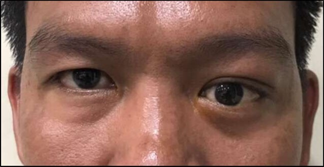 Adenoid cystic carcinoma