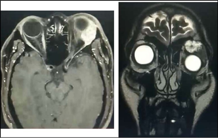 Adenoid cystic carcinoma