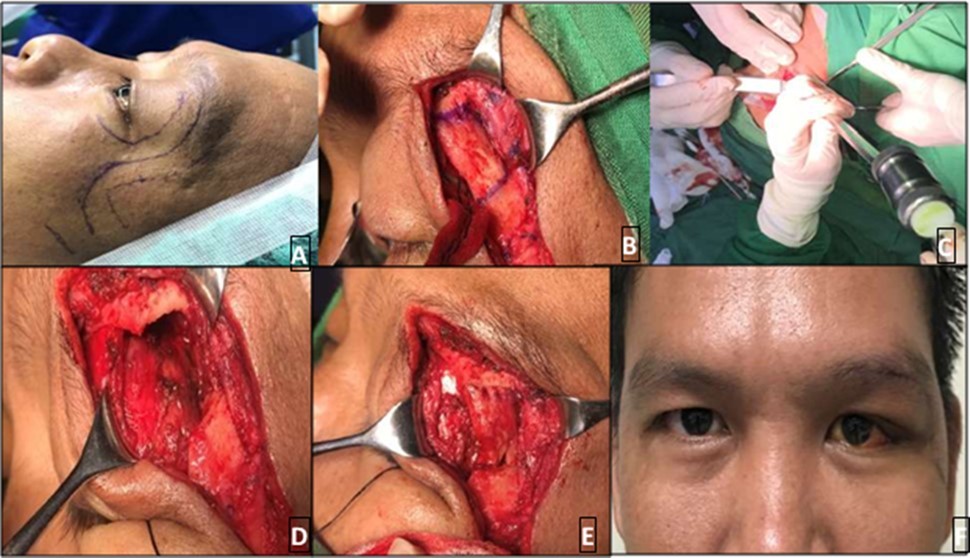 Adenoid cystic carcinoma