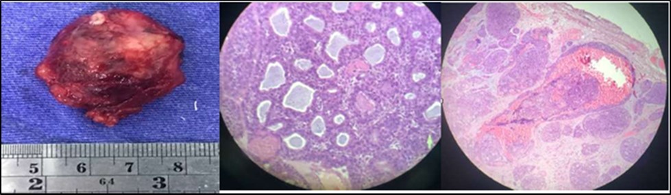 Adenoid cystic carcinoma