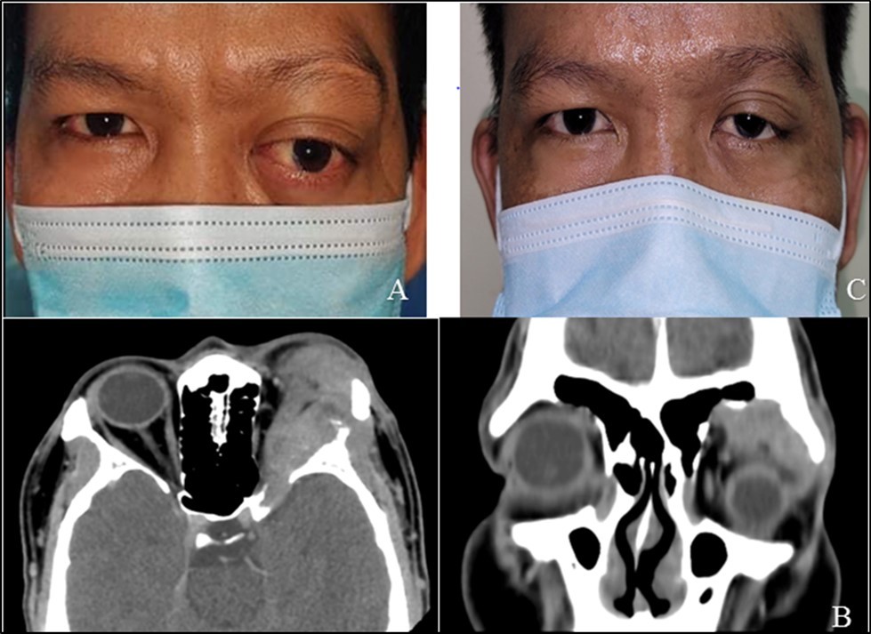 Adenoid cystic carcinoma