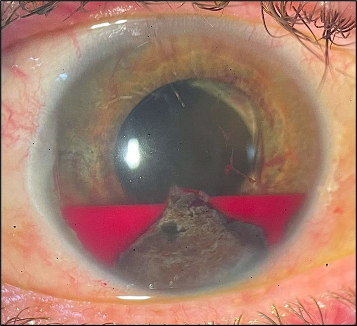eye on fire