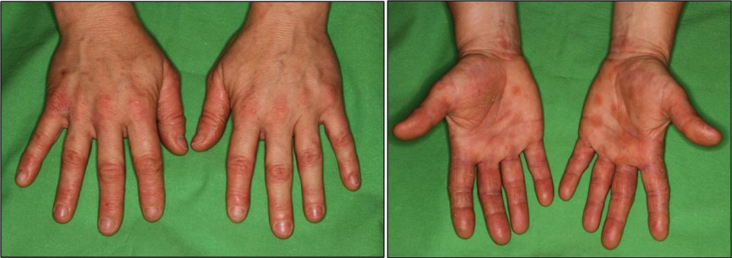 Journal of Dermatologic Research And Therapy-lavender oil