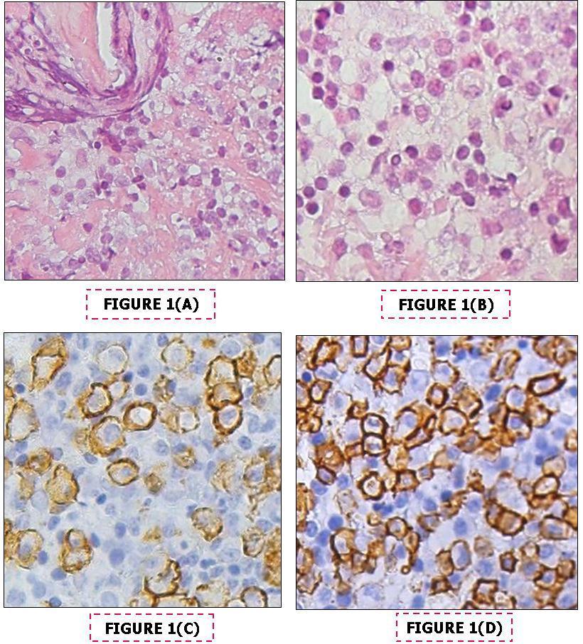 Journal of Hematology and Oncology Research-Immunotactoid glomerulonephritis-Waldenstrom's macroglobulinemia-lymphoplasmacytic lymphoma-End-stage-renal disease