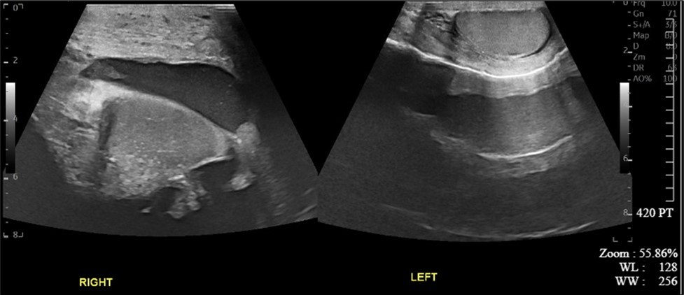 Journal of Clinical Case Reports and Images - Giant Hydrocele