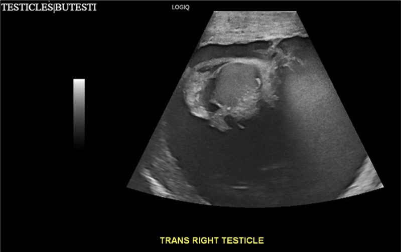 Journal of Clinical Case Reports and Images - Giant Hydrocele