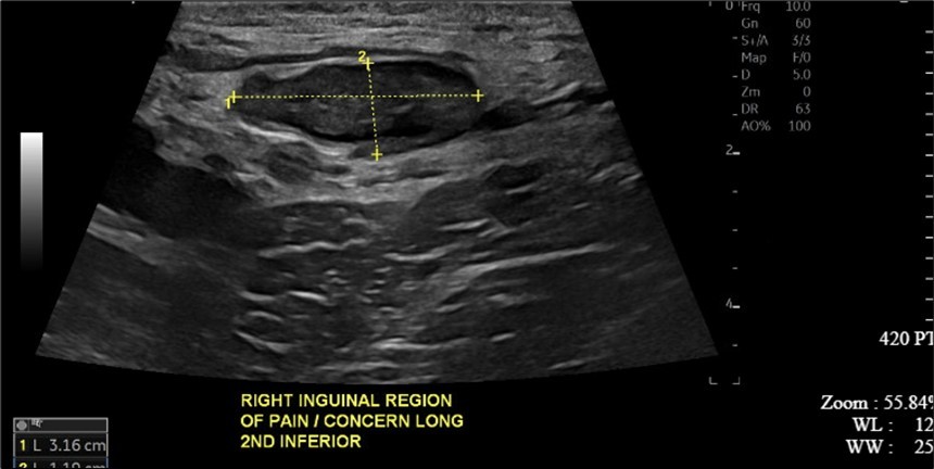 Journal of Clinical Case Reports and Images - Giant Hydrocele