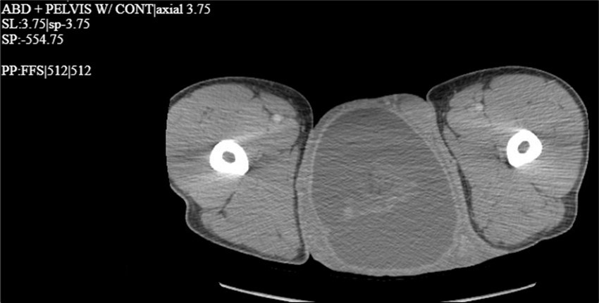 Journal of Clinical Case Reports and Images - Giant Hydrocele
