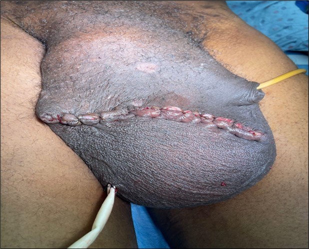 Journal of Clinical Case Reports and Images - Giant Hydrocele
