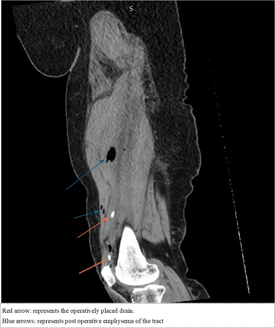 Journal of Sports and Exercise Medicine - Knee Septic Arthritis