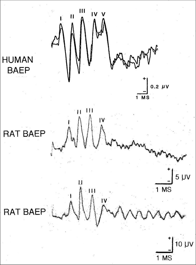 Journal of Otolaryngology Advances - The Brainstem Auditory Evoked Potential