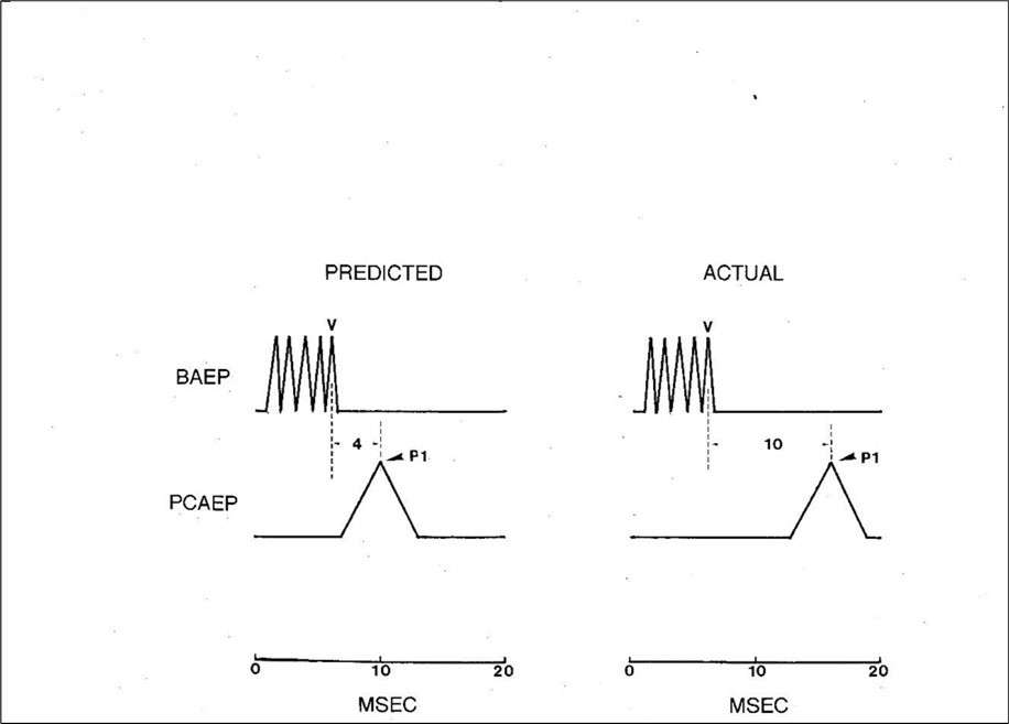 Journal of Otolaryngology Advances - The Brainstem Auditory Evoked Potential