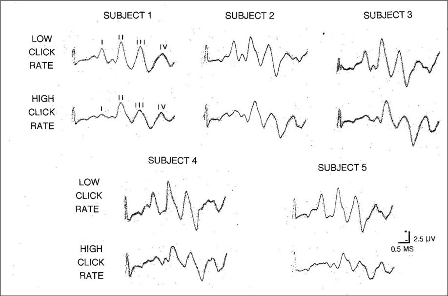 Journal of Otolaryngology Advances - The Brainstem Auditory Evoked Potential