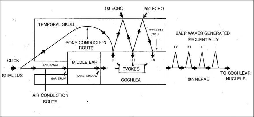 Journal of Otolaryngology Advances - The Brainstem Auditory Evoked Potential