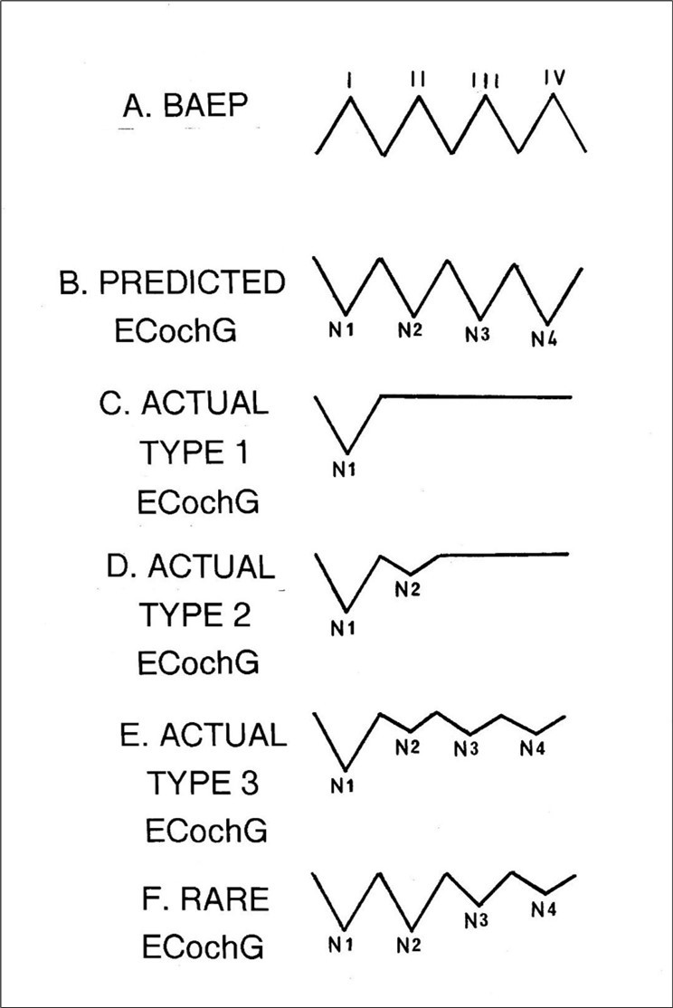 Journal of Otolaryngology Advances - The Brainstem Auditory Evoked Potential