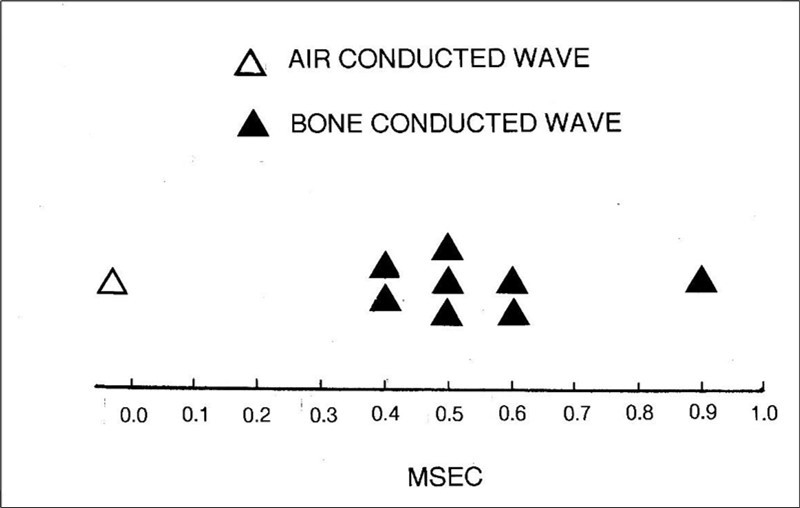 Journal of Otolaryngology Advances - The Brainstem Auditory Evoked Potential