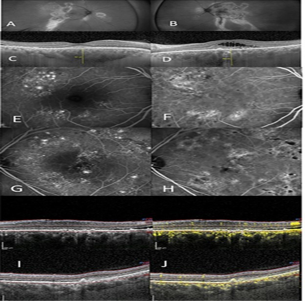 Journal of Ophthalmic Science - Optical Coherent Tomography (Angiography)