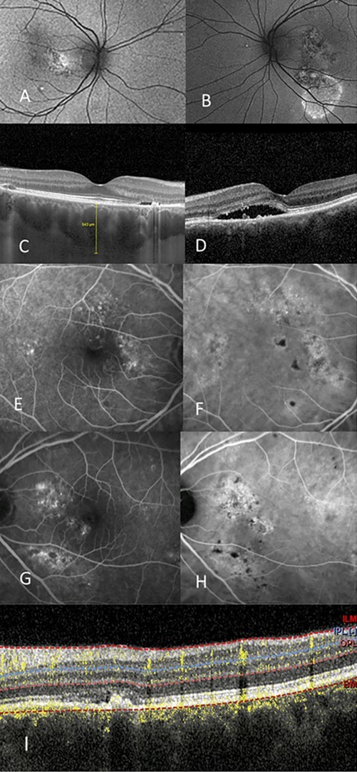 Journal of Ophthalmic Science - Optical Coherent Tomography (Angiography)