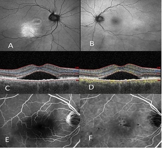 Journal of Ophthalmic Science - Optical Coherent Tomography (Angiography)