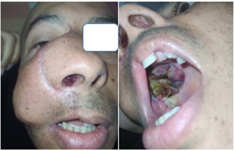 Journal of Otolaryngology Advances - Radio-Induced Maxillary