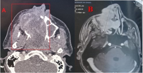 Journal of Otolaryngology Advances - Radio-Induced Maxillary