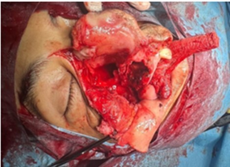Journal of Otolaryngology Advances - Radio-Induced Maxillary