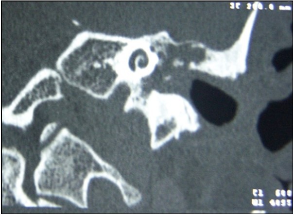 Journal of Otolaryngology Advances-cholesteatoma