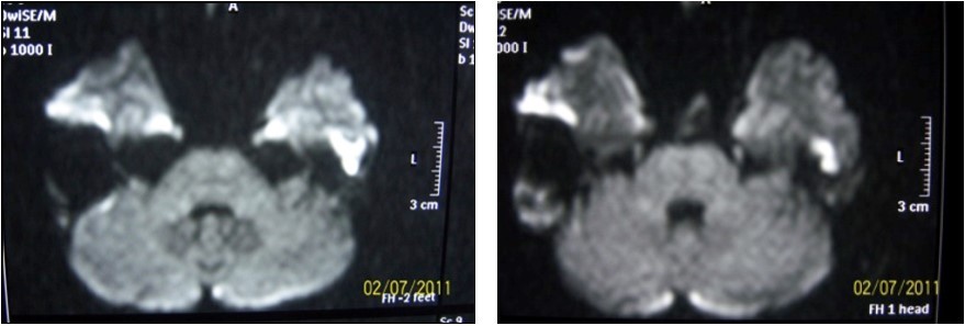 Journal of Otolaryngology Advances-cholesteatoma