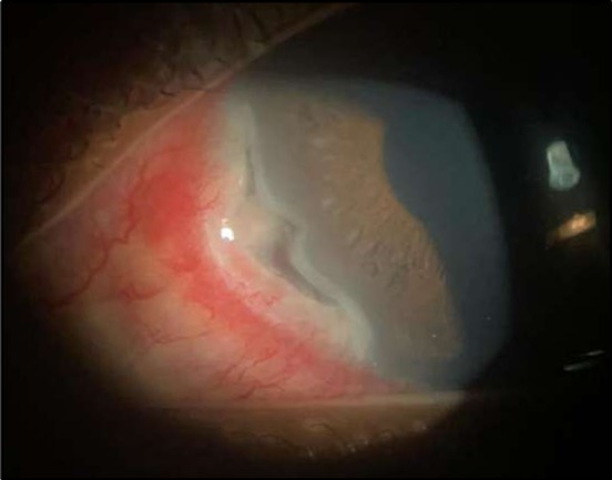 Journal of Ophthalmic Science - Conjunctival Resection