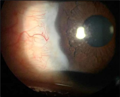 Journal of Ophthalmic Science - Conjunctival Resection