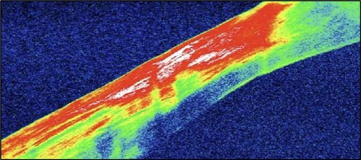 Journal of Ophthalmic Science - Conjunctival Resection