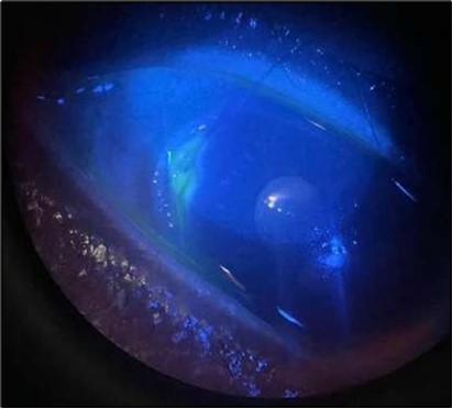 Journal of Ophthalmic Science - Conjunctival Resection