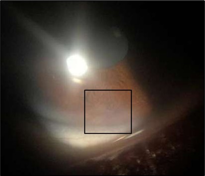 Journal of Ophthalmic Science - Conjunctival Resection