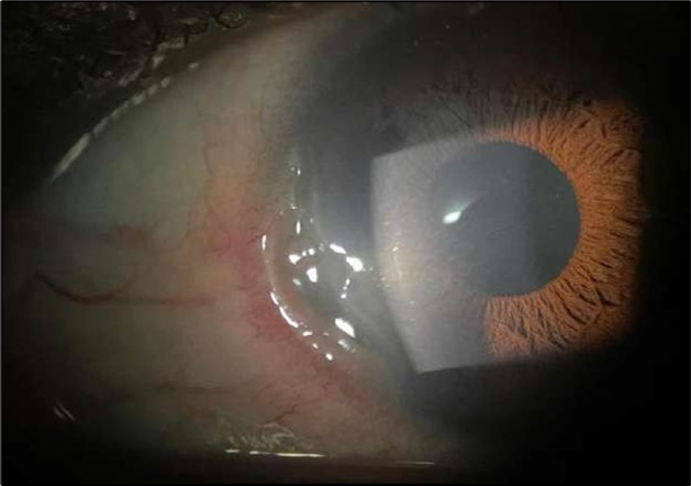 Journal of Ophthalmic Science - Conjunctival Resection
